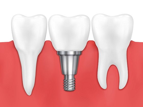 implantes dentales gavá