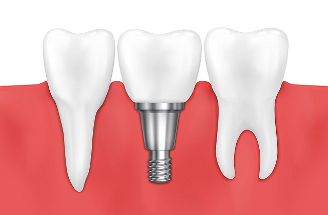 implantes dentales gavá